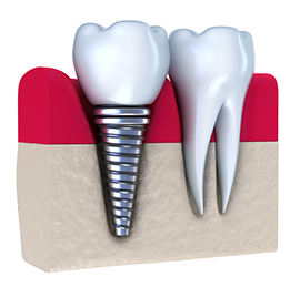 illustration of real tooth and roots next to dental implant, Shrewsbury, NJ